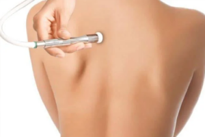 Back Facial with Microdermabrasion