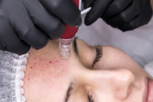 Microneedling