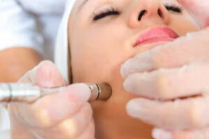 Microdermabrasion