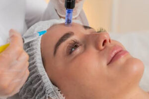 BB Glow with Microneedling