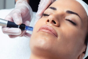Microneedling + Exosomes