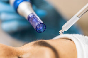 MICRONEEDLING + PDRN (SALMON DNA)